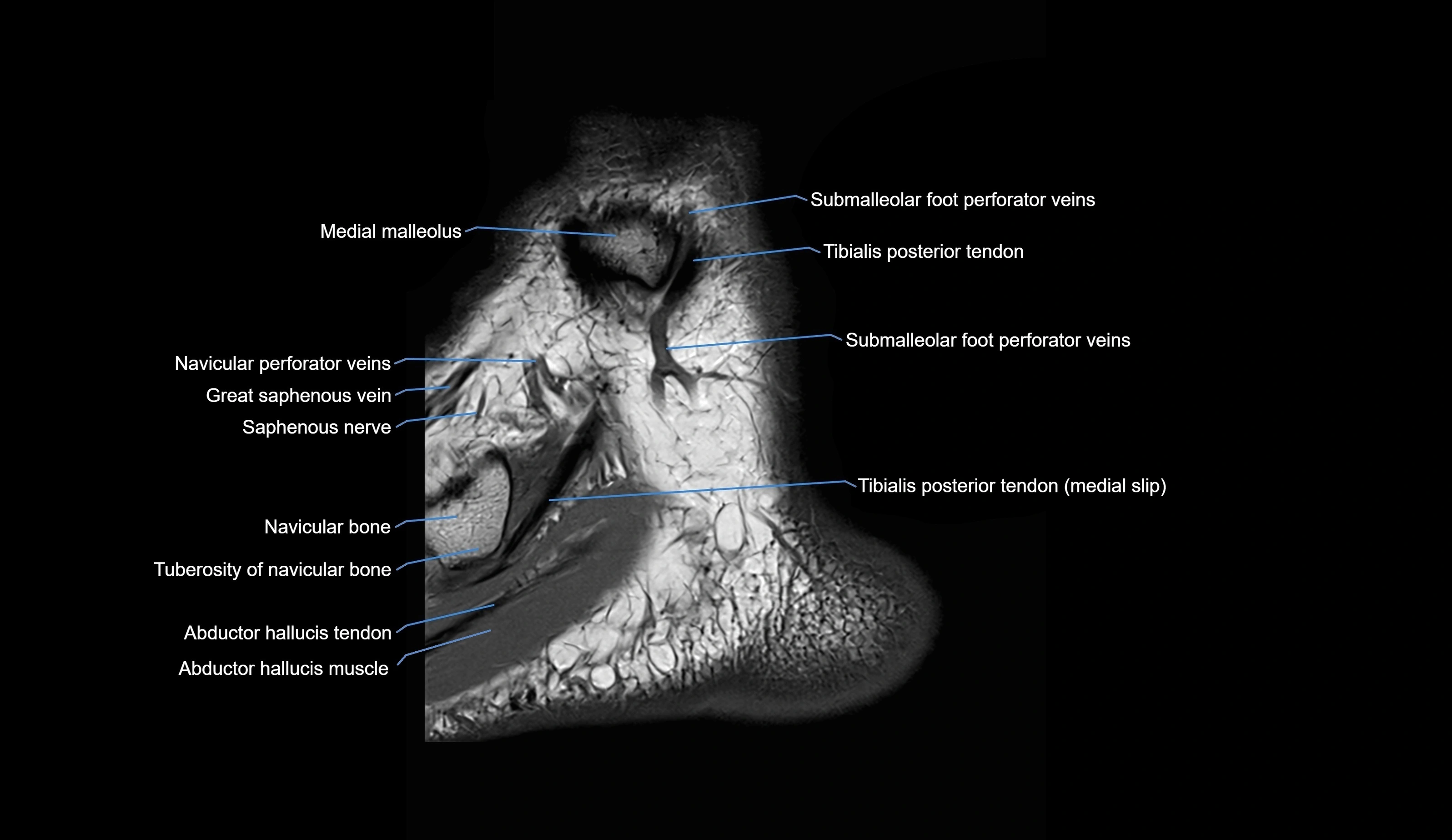 MRI Ankle sagittal cross sectional anatomy 3T  radiology  image-img-00001-00003.webp